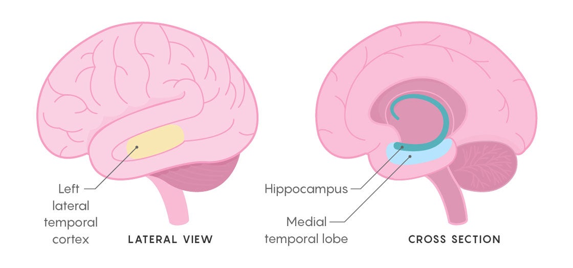 LateralTemporalCortex__560